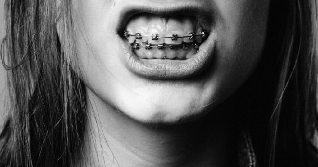 braces