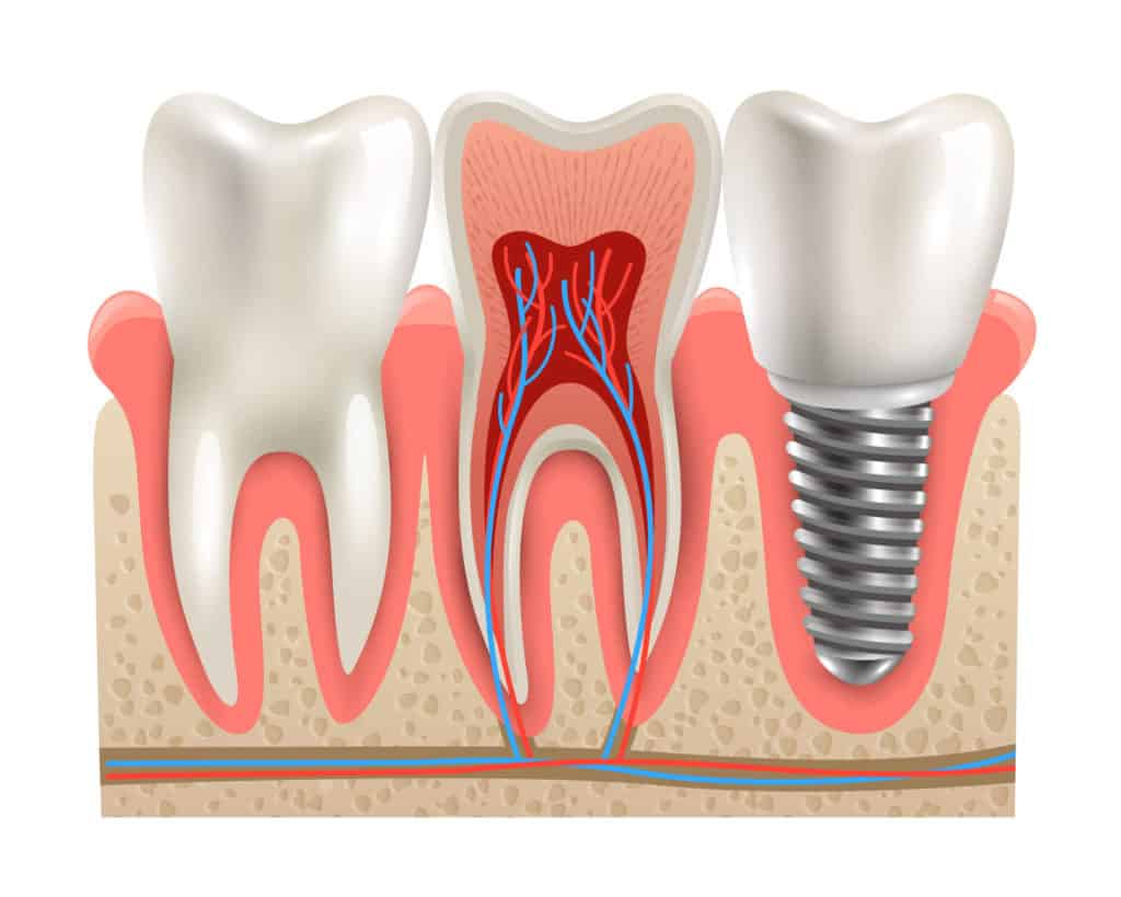 dental implant